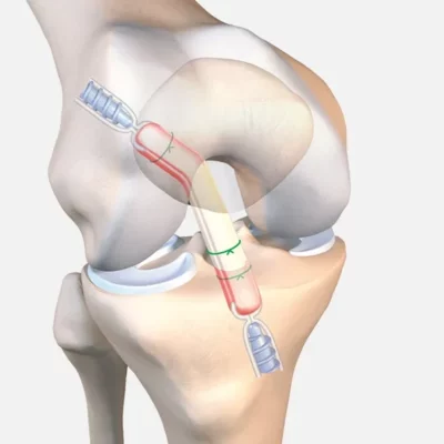 Tape Locking Screw (TLS®) system