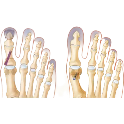 bePOD 3A & percutaneous screw, Abbildung 3