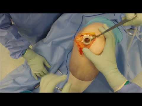 Episealer Solo Left Medial Femoral Condyle